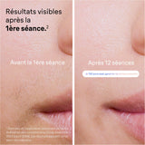 Epilateur a lumiere pulsée - BRAUN - IPL PL7253 - 240 V - 400 000 Flashs - Or rose / Blanc