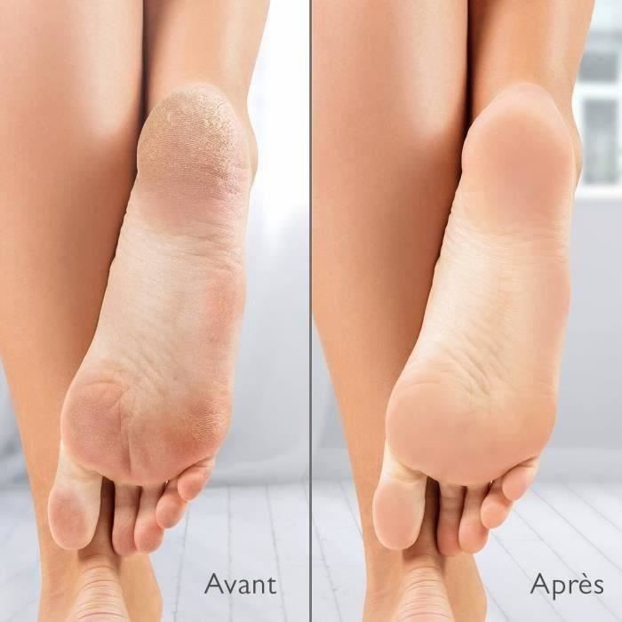 Râpe électrique anti-callosités Silk'n Vacupedi avec aspiration intégrée et 2 râpes incluses